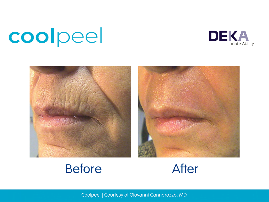 Laser Skin Resurfacing: CoolPeel, CO2 Laser - Maryland